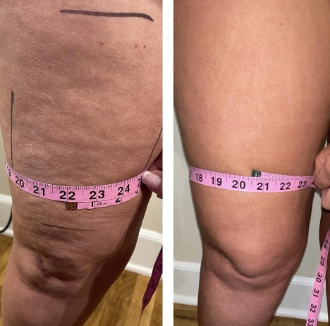 sentient sculpt treatment measurement b&a7