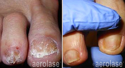 Nails Fungus Treatment before & after