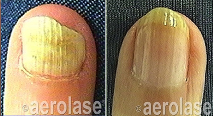 Nails Fungus Treatment before & after