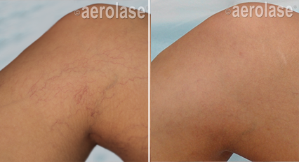 Spider Veins Treatment before & after