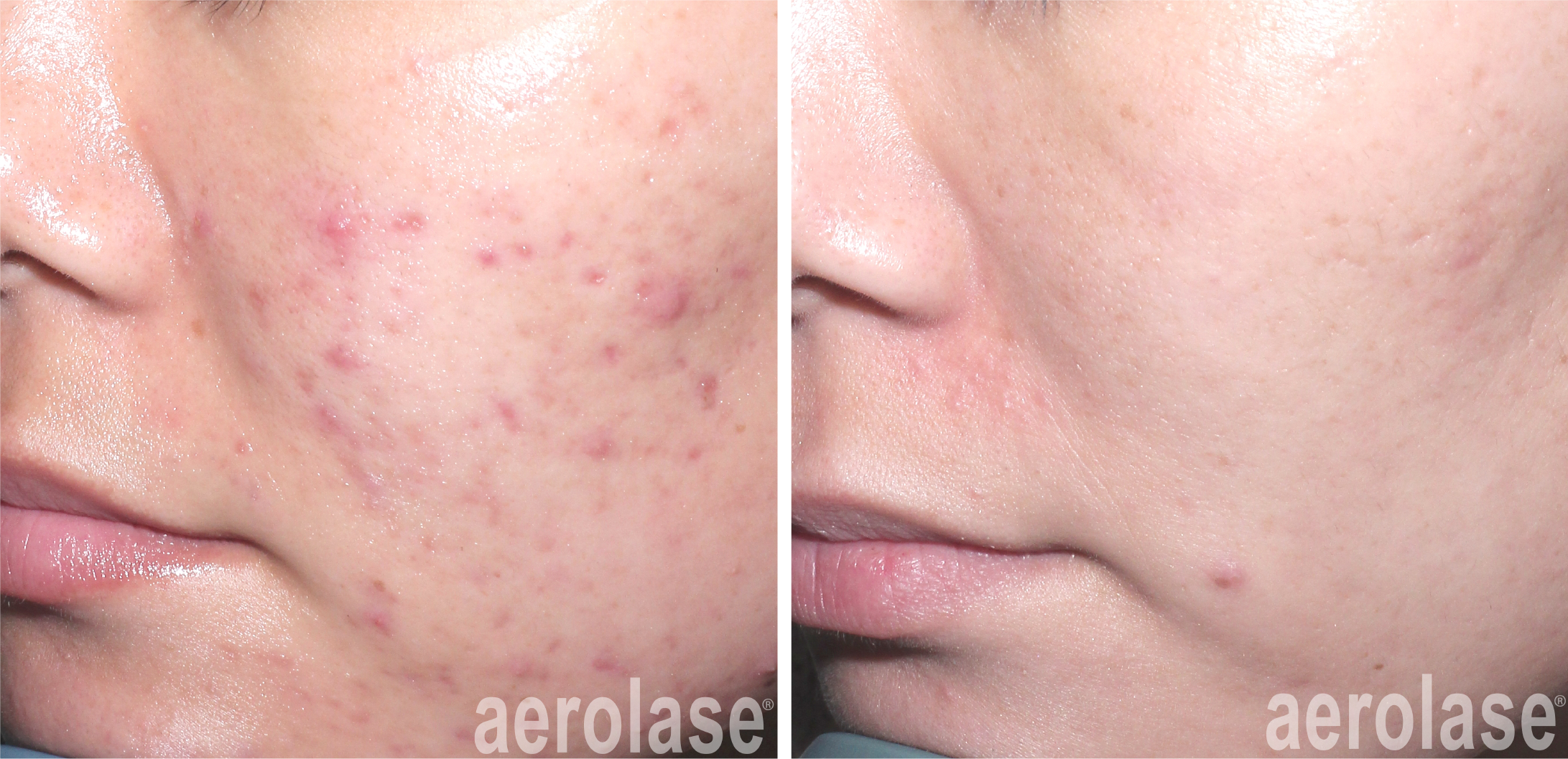 aerolase acne before after 6 treatments