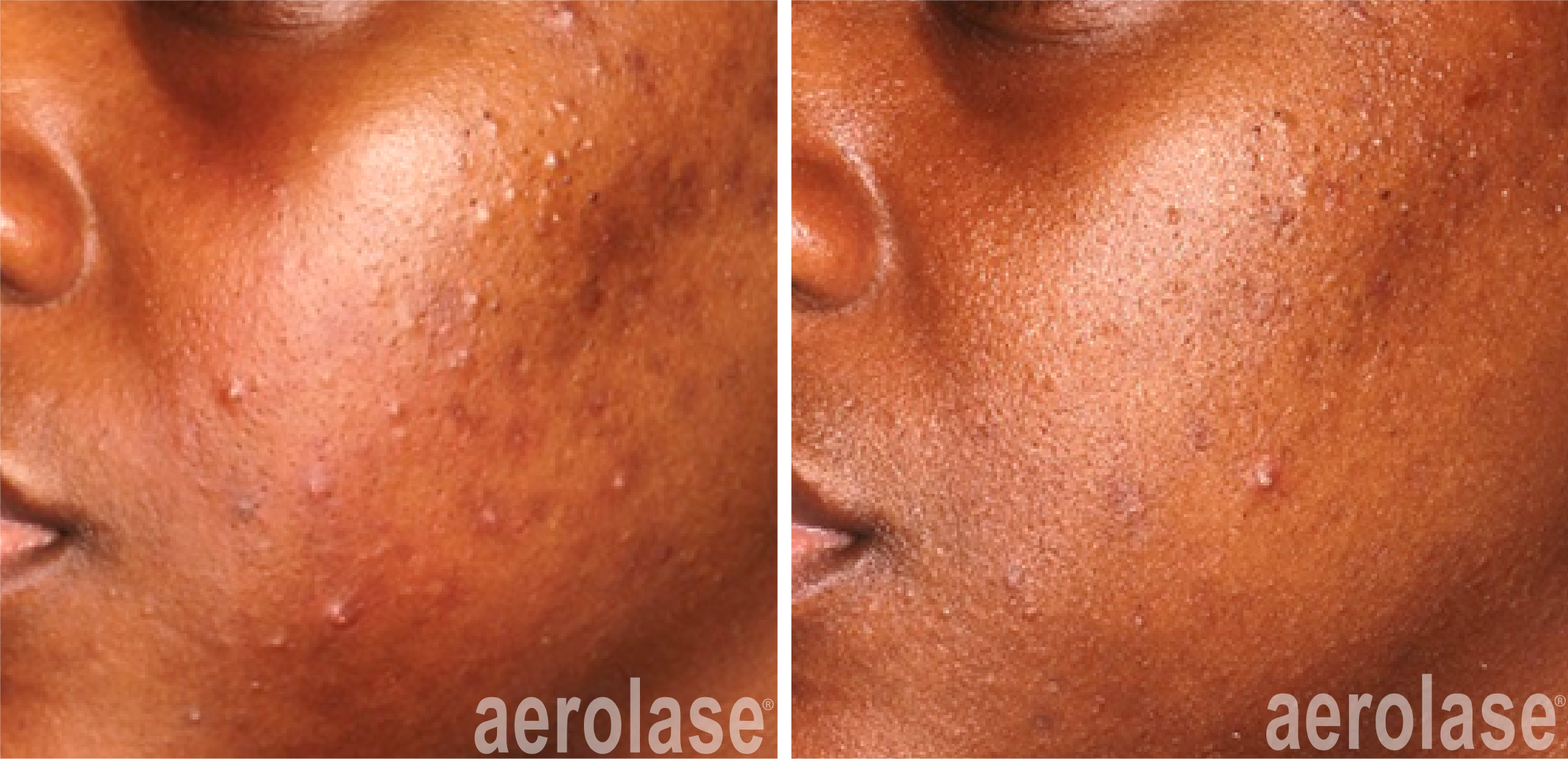 aerolase before after michelle henry 4 treatments