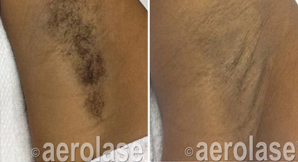 Hair Removal Underarm