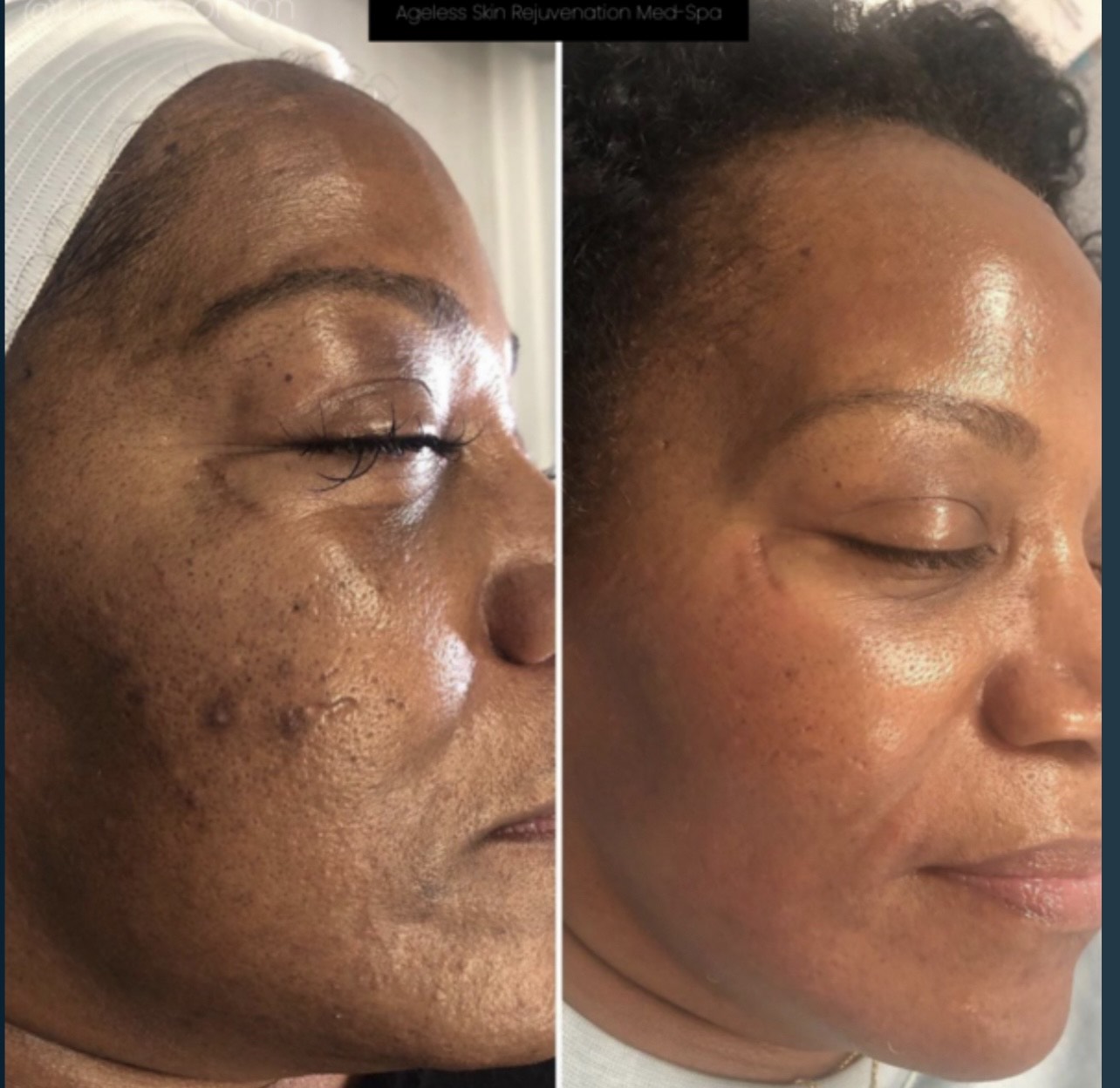 NeoSkin Acne Treatment before and after