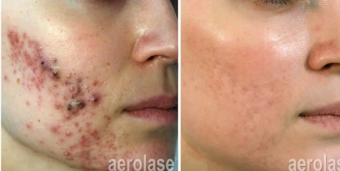 Acne Treatment with NeoSkin before and after