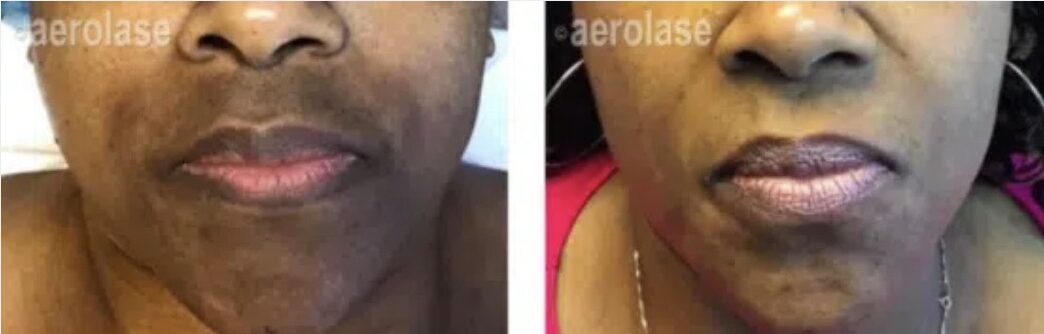 Laser treatment on dark skin for melasma