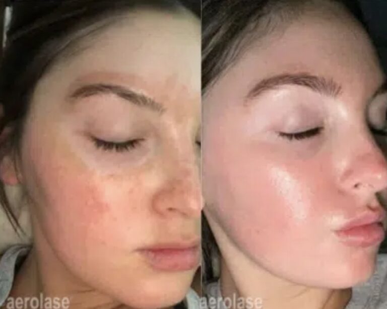 solving melasma, hyperpigmentation