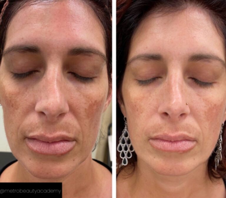 Laser treatment on face for melasma