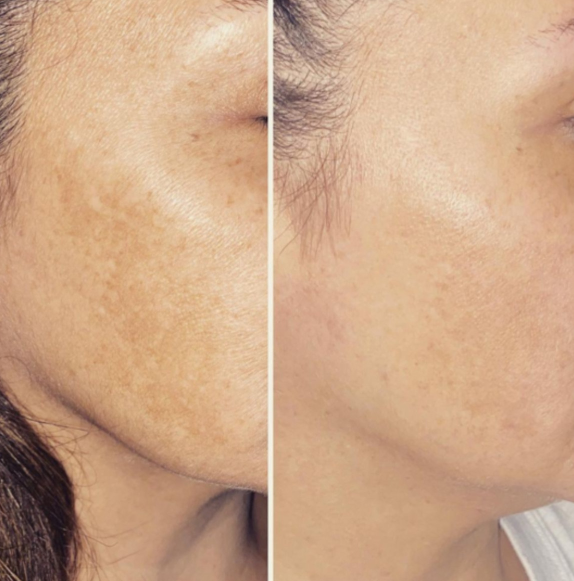 Laser treatment on face for melasma, hyperpigmentation