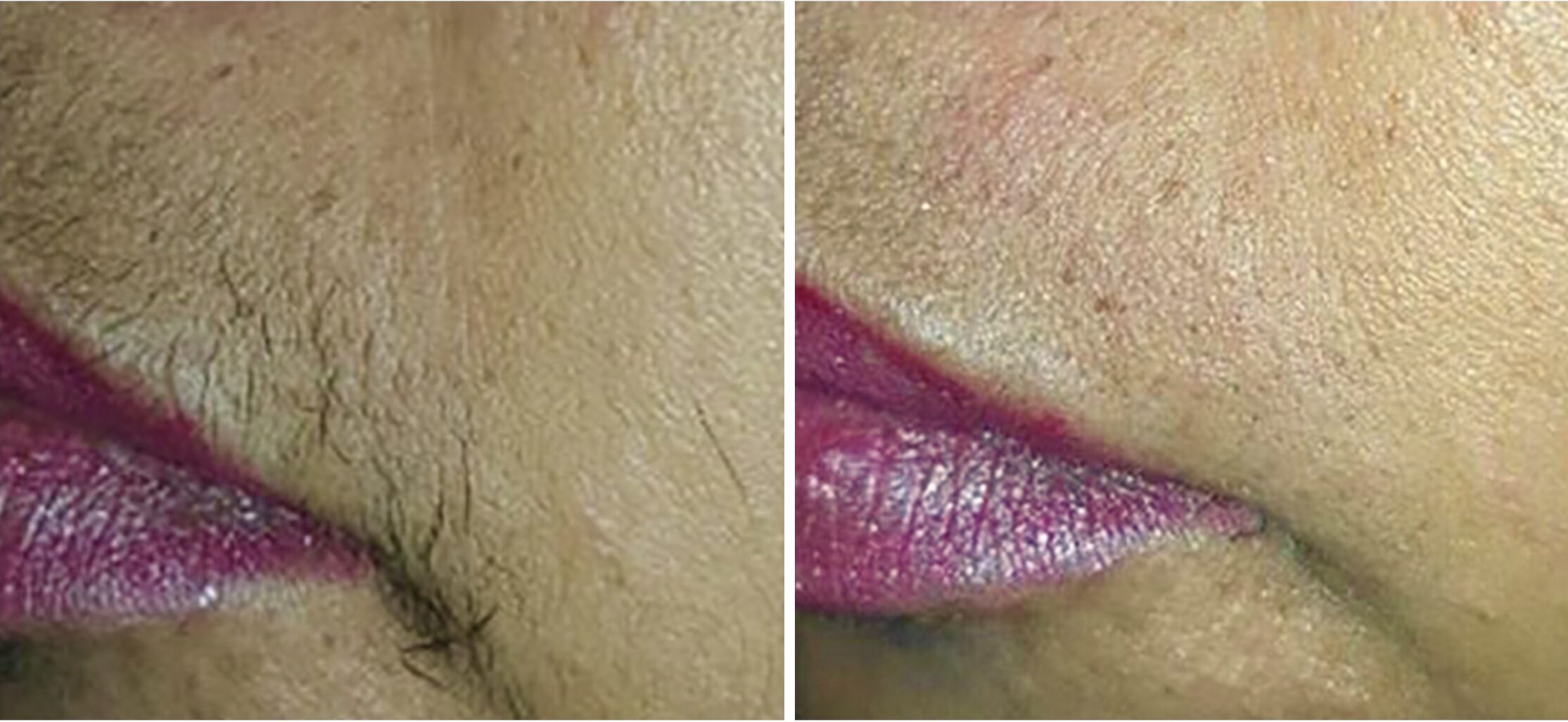 Upper lip laser hair removal, woman