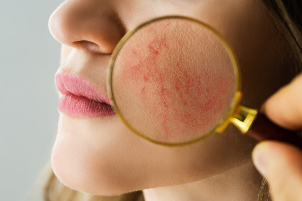 Correcting Rosacea, skin redness, spider veins, red bumps