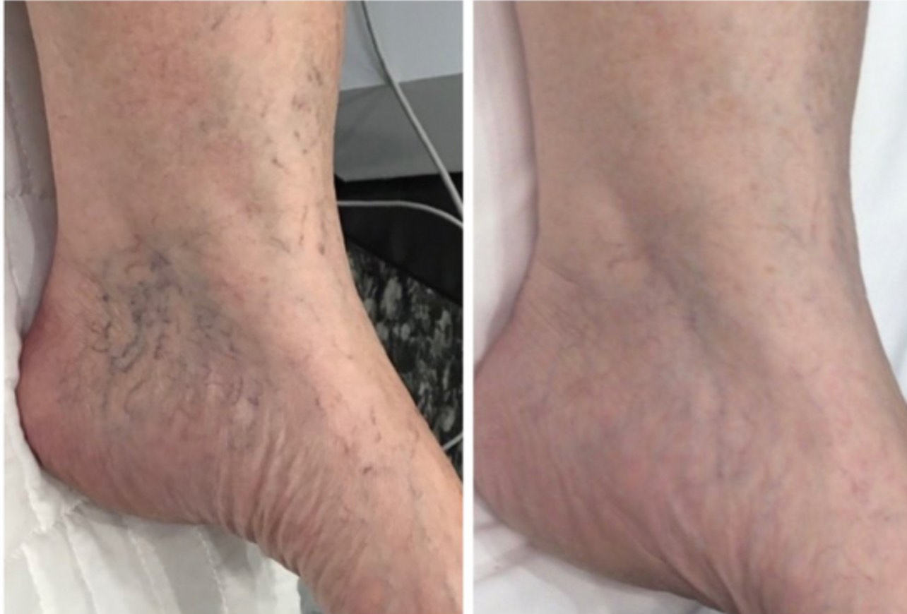 NeoSkin Spider Vein treatment