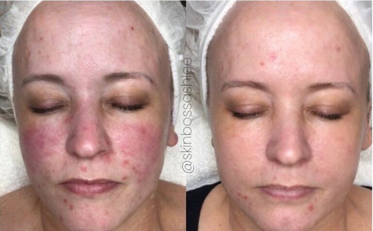 Correcting Rosacea, red bumps (Cherry Angiomas) and broken capillaries