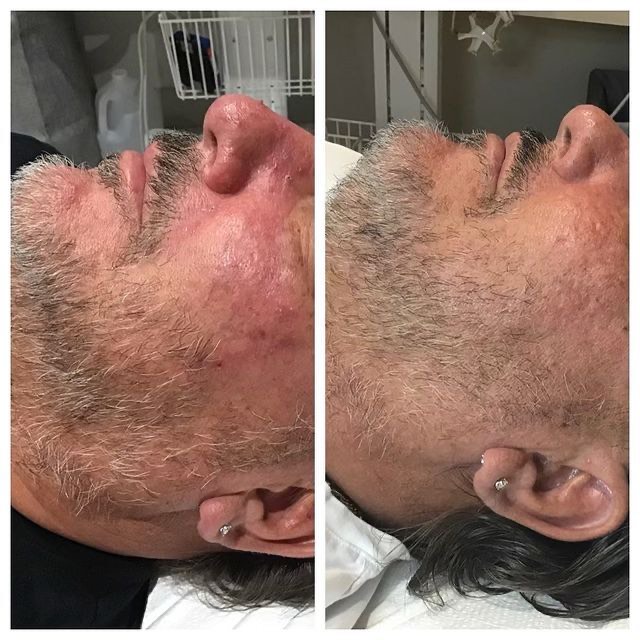 NeoSkin treatment for rosacea and redness male