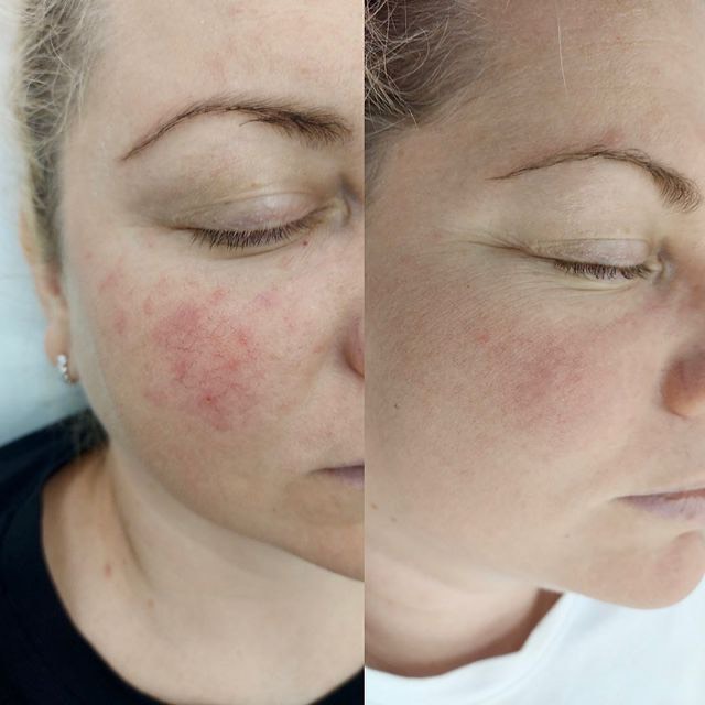 NeoSkin for correcting Rosacea, red bumps (Cherry Angiomas)