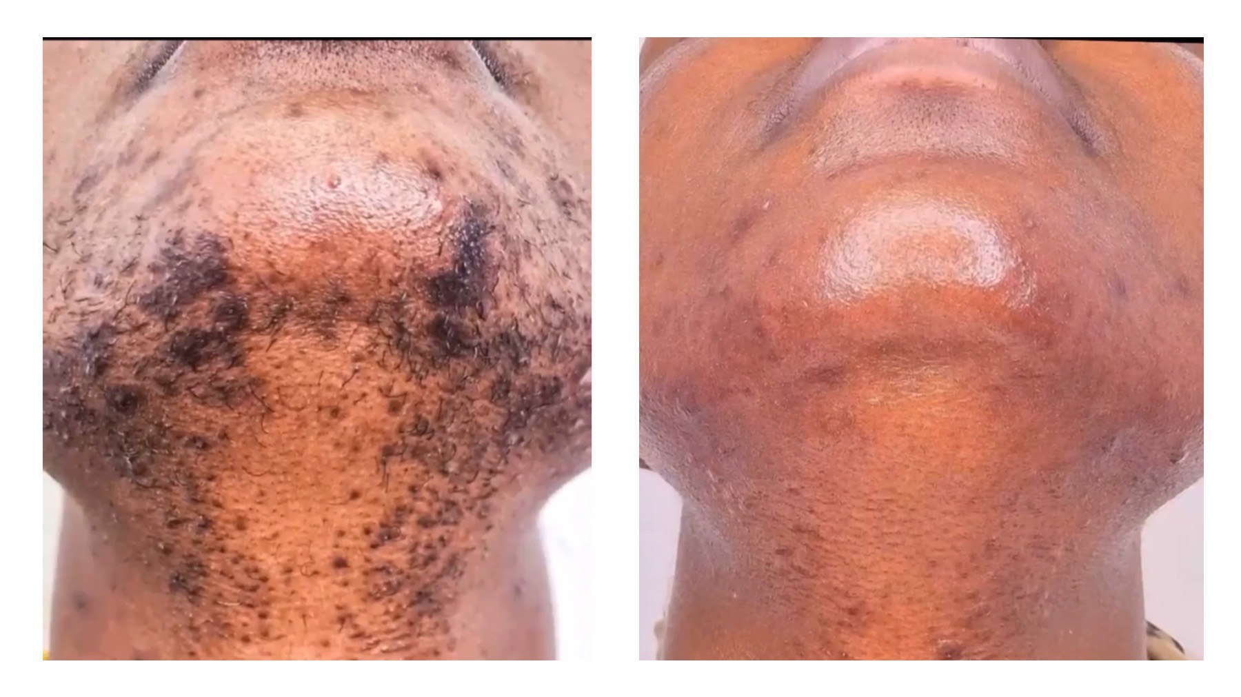 Ingrown hair laser treatments