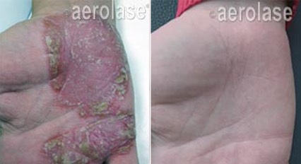 Treatments for psoriasis