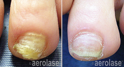 nail fungus service before & after