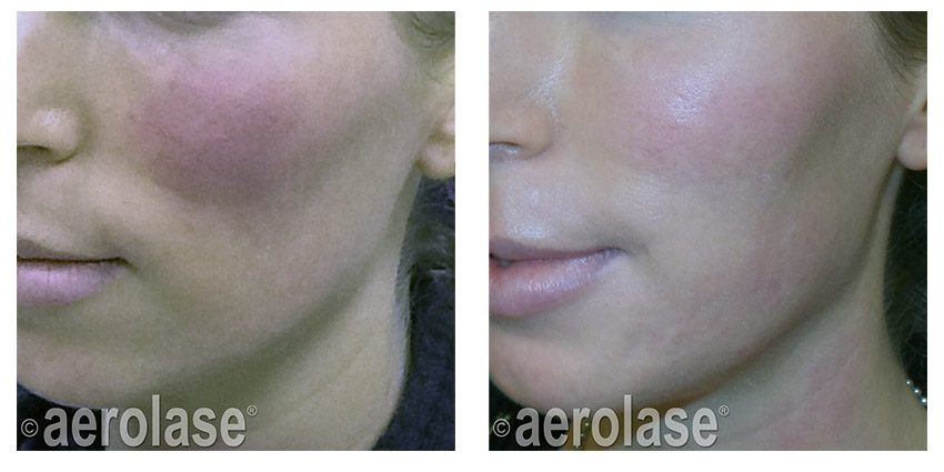 NeoSkin Rosacea After 1 Treatment Kevin Pinski MD