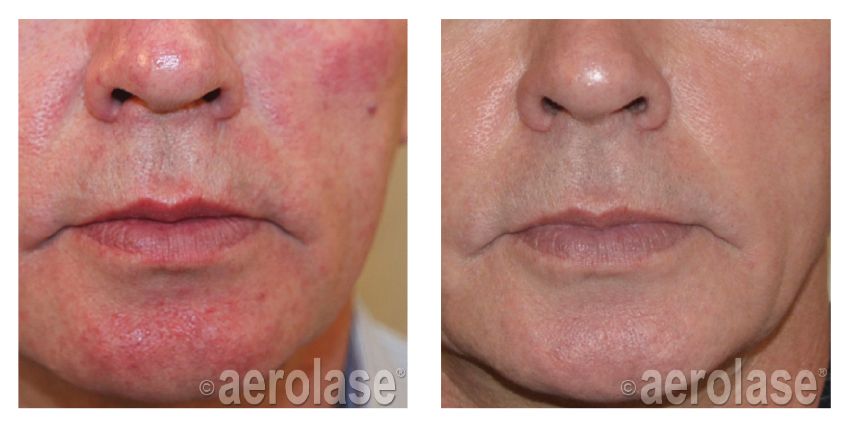 NeoSkin Rosacea After 2 Treatments Natalia Geraskova MD