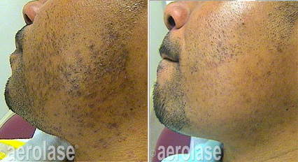 Ingrown Hair, PFB before & after male