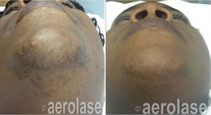 Ingrown Hair, PFB chin before & after female