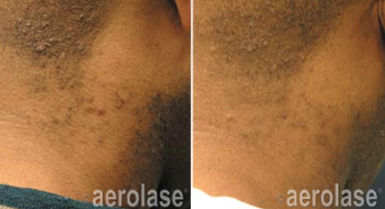 Ingrown Hair, PFB before & after