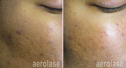 Pigmented Spots female Before & After