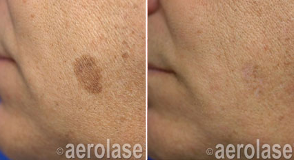 Pigmented Spots Before & After