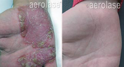 Psoriasis laser treatment