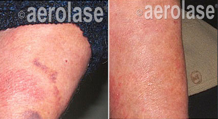 Psoriasis laser treatment arm