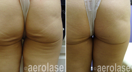 skin rejuvenation buttocks & thighs